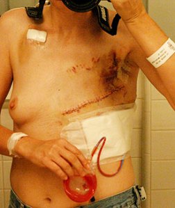 Mastectomy and the body changing impact